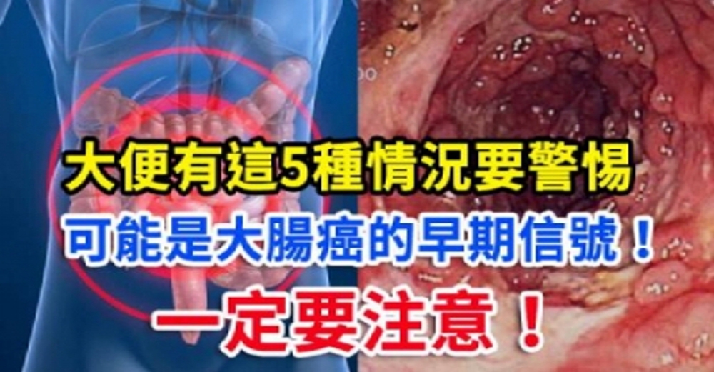 注意!大便有這5種情況要警惕, 可能是大腸癌的早期信號!!